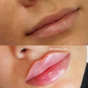 Курс Бьютификация губ