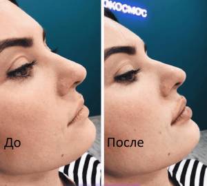 Увеличение губ в Москве