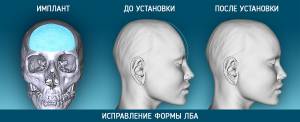 Краниопластика