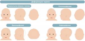Детская остеопатия