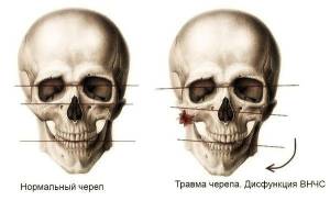 Асимметрия черепа