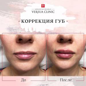 Увеличение и коррекция формы губ в Москве в Versua Clinic, цены на увеличение губ, отзывы