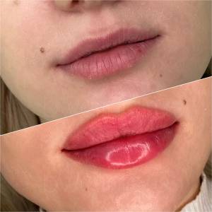 Увеличение губ гиалуроновой кислотой