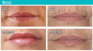 Коррекция губ в косметологической клинике «ИнтерМедЦентр»