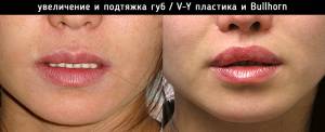 Хейлопластика