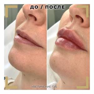 Техники увеличения губ