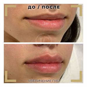 Техники увеличения губ