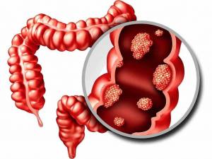 Рак толстой кишки