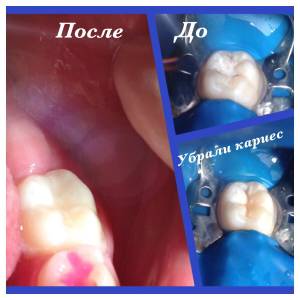 Лечение кариеса и восстановление анатомической формы жевательного зуба
