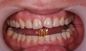 Восстановление формы передних зубов с помощью керамических виниров