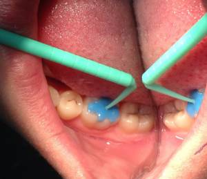 Шаблон для моделирования жевательной поверхности зубов