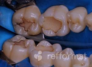 Восстановление анатомической формы зубов, лечение кариеса