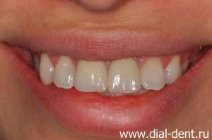 Керамические коронки для коррекции формы и цвета передних зубов