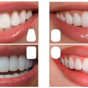 Дизайн улыбки