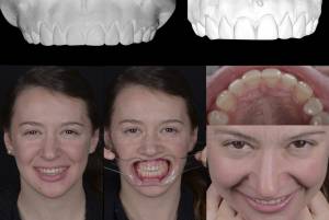 Анализ лица и улыбки