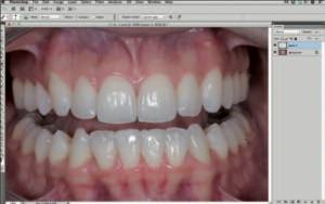 Анализ улыбки и ее моделирование с помощью программы Photoshop