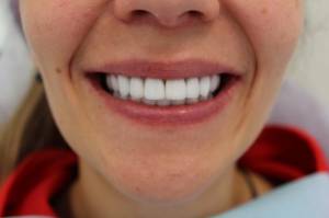 Как выглядят виниры