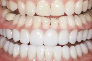 Художественная реставрация зубов, что это?