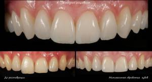 Керамические коронки в Кургане