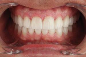 Семь главных нарушений при формировании дизайна улыбки