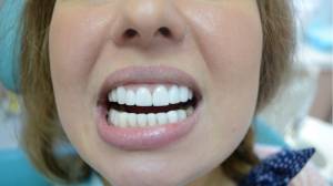 Художественная реставрация передних зубов в Челябинске