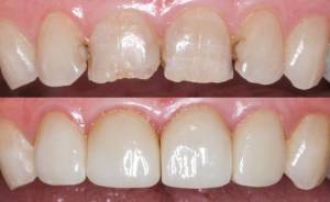 7 советов для прямой реставрации фронтальной группы зубов