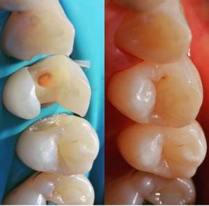 Лечение криеса на контактных поверхностях и восстановление анатомической формы премоляров