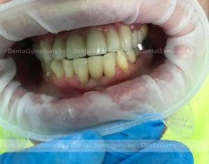 Шинирование зубов и восстановление анатомической формы зуба