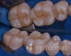 Восстановление анатомической формы зубов, лечение кариеса